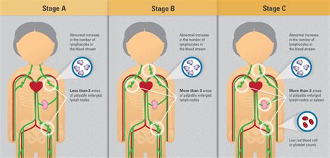 Staging CLL - CLL Ireland