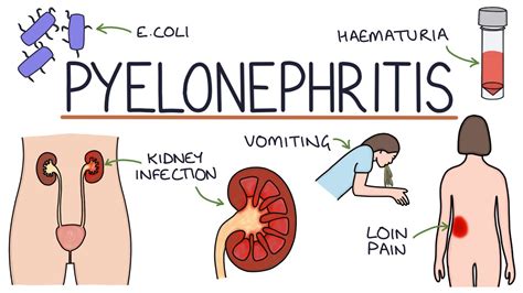 Understanding Pyelonephritis (Kidney Infections) - YouTube