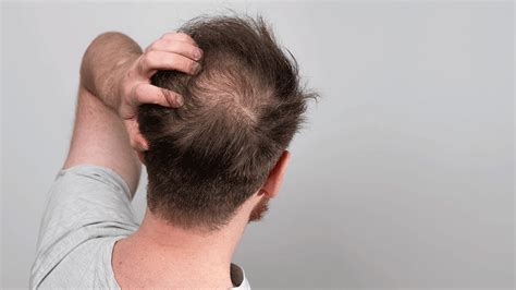 Scalp Inflammation & Hair Loss: The Connection Explained | Pilot