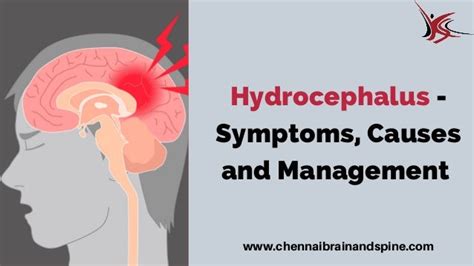 Hydrocephalus - Symptoms, Causes And Management