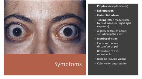 Underactive Thyroid Symptoms Eye Problems - Infoupdate.org