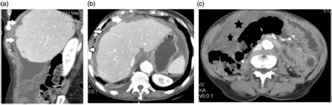 Metastatic mucinous adenocarcinoma, probably ovarian in origin. (a ...