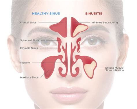 nose - CHRONIC MAXILLARY SINUSITIS - Dr. Meenesh Juvekar - ENT Specialist