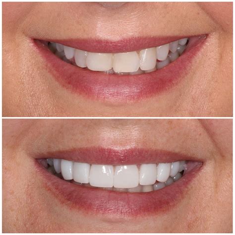 Composite Veneers Brisbane [Free Consult] | Smiling Dental