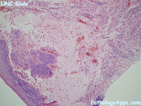 mucocele pathology