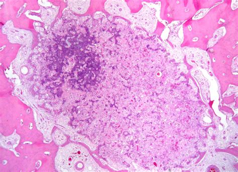 Osteoid Osteoma Histology