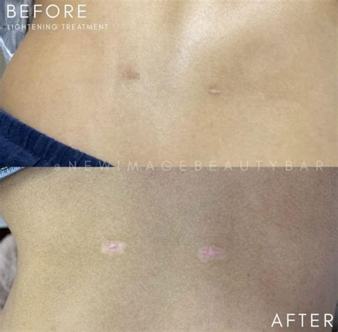 How to Get Rid of Surgical Scars? - New Image Beauty Bar