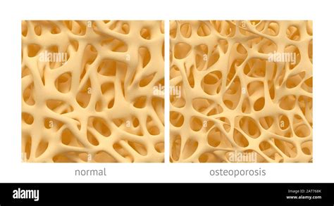 Spongy Bone Disease