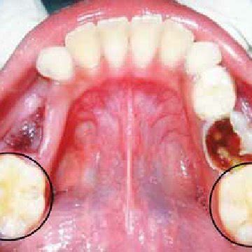 Mandibular first permanent molar exhibiting six cusps | Download ...