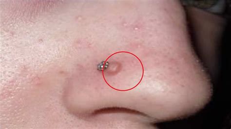 how to get rid of nose piercing bump with toothpaste - YouTube