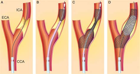 Carotid Artery Stenting Outcomes Vary Widely by Hospital | News & Blog ...