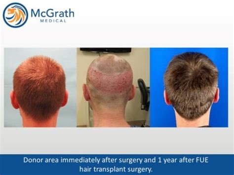 Follicular Unit Extraction | FUE Hair Transplantation | Neograft ...