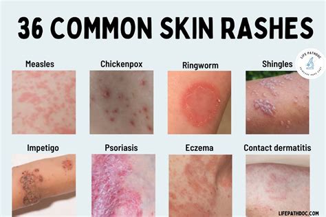 Types Of Skin Rashes On Face - Printable Templates Protal