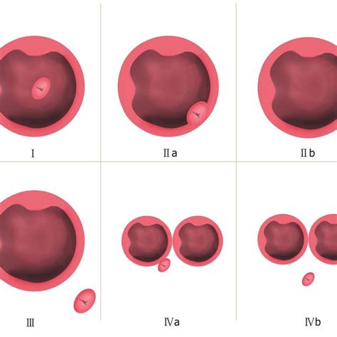 Li-Tanaka classification of periampullary diverticulum. Type I: The ...