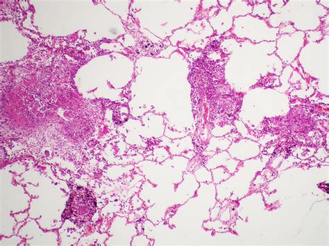 Disseminated Tuberculosis