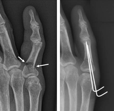 4th Proximal Phalanx Fracture