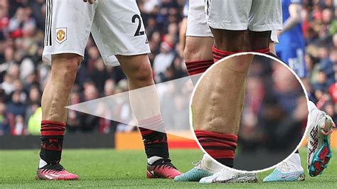 Man Utd fans just noticing 'gnarly' scar on Luke Shaw's leg from horror ...