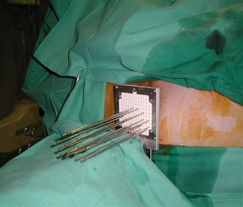 High-Dose-Rate Interstitial Brachytherapy as Monotherapy in One ...