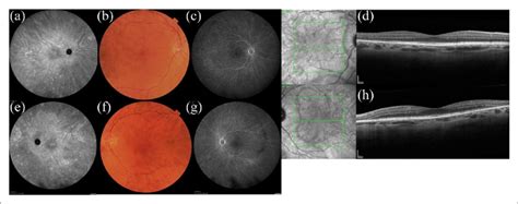 Multimodal imaging of AZOOR at presentation. Hyperfluorescent dots in ...