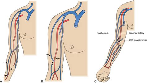 Hemodialysis access | Radiology Key