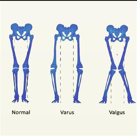 Varus Vs Valgus