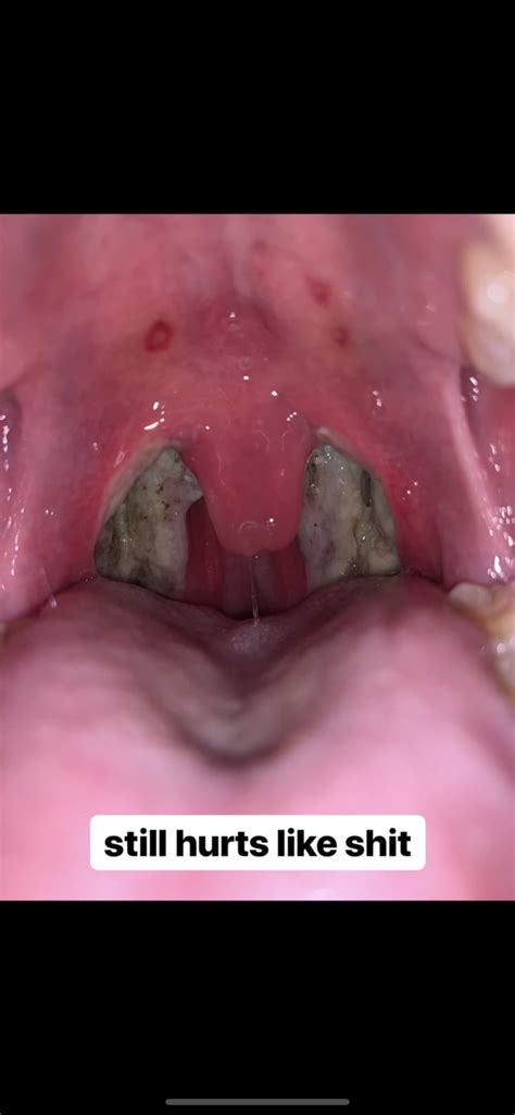 tonsillectomy tomorrow morning : r/Tonsillectomy