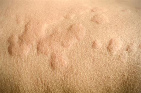 Itchy skin (pruritus): Causes, treatment, and home remedies