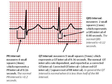 Normal Qrs Time