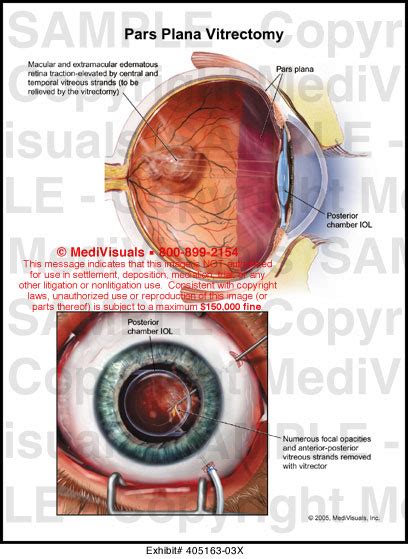 Medivisuals Pars Plana Vitrectomy Medical Illustration