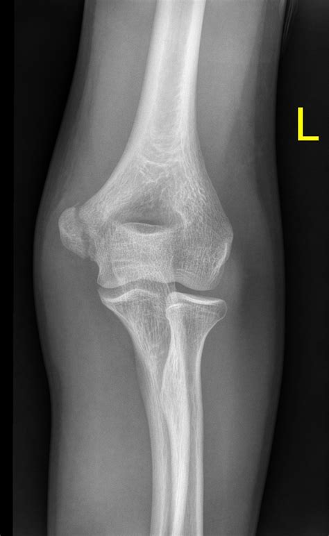 Medial Epicondyle Humerus