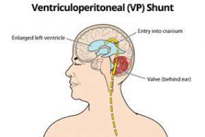 Best Ventriculoperitoneal (VP) Shunt Treatments Hospital & Doctors in ...