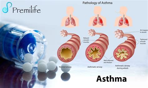 Asthma - Premilife - Homeopathic Remedies