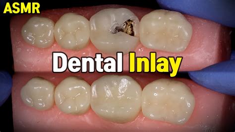 Dental Inlay Procedure - YouTube