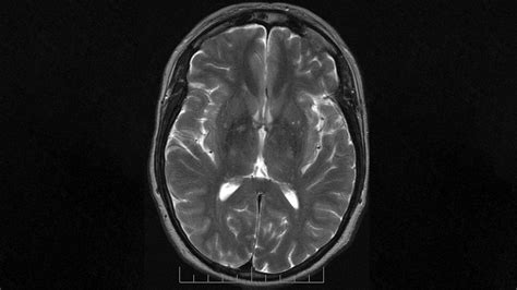 Mri Images Of The Brain