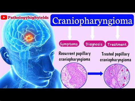 Craniopharyngioma-high yields.3 Worst signs and Symptoms of ...