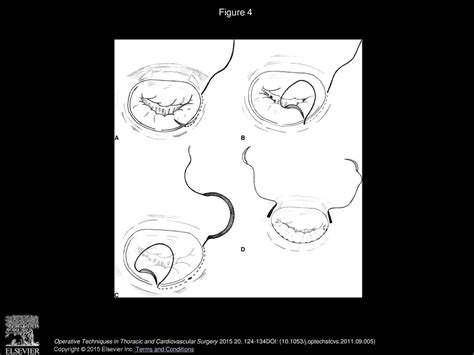 Mitral Annuloplasty Using A Biodegradable Annuloplasty Ring - ppt download