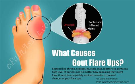 What Causes Gout Flare Ups & How to Get Rid of it? Exercise For ...