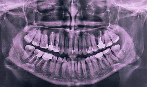 Dental and Mouth Related Personal Injuries | Dolman Law Group