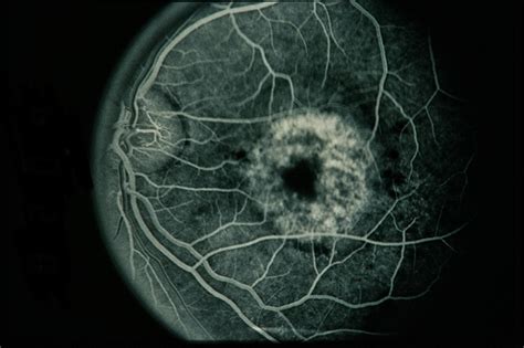 Choroidal Hemangioma - Retina Image Bank