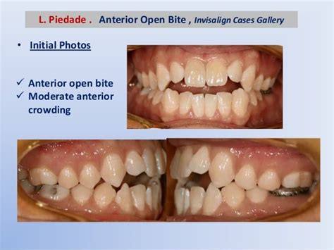 Anterior open bite treatment in the permanent dentition part 2-