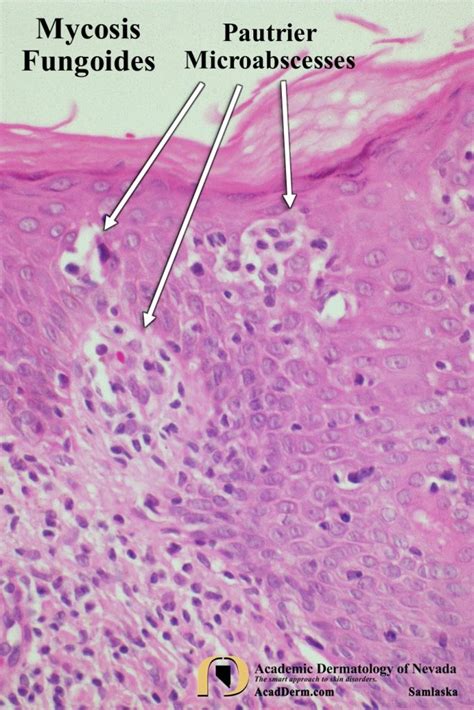 Mycosis Fungoides: Cutaneous T-cell Lymphoma... - Academic Dermatology ...