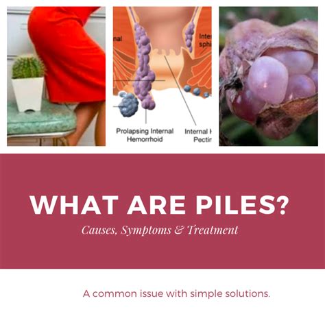 How To Ease Piles - Northernpossession24