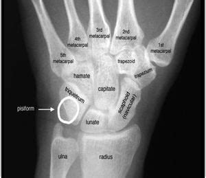 Trapezoid Bone Fracture