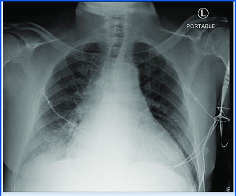 Case 1: Initial chest x-ray with cardiomegaly, pulmonary venous ...