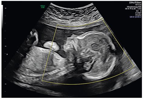 Impact of 3D ultrasound on fetal CNS examination | proLékaře.cz