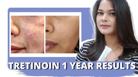 TRETINOIN BEFORE AND AFTER | 1 year Tretinoin Experience and Review ...