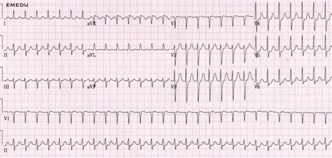 ECG (EKG) examples and quiz - Oxford Medical Education