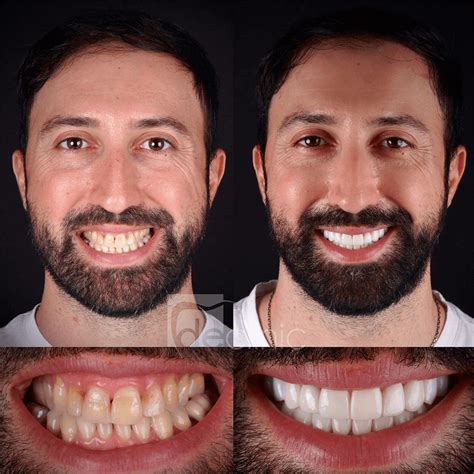 Smile Makeover - Dental Excellence Turkey | Dental Clinic in Antalya Turkey