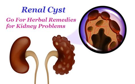 Renal Cyst – Go For Herbal Remedies for Kidney Problems - Kundan Kidney ...