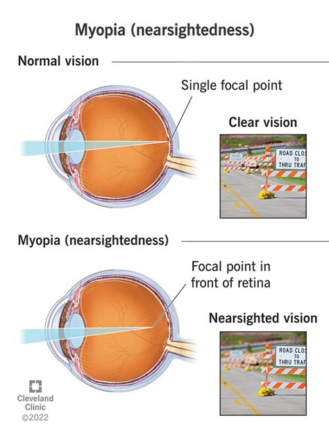 Myopia (Nearsightedness): Causes, Symptoms &Treatment